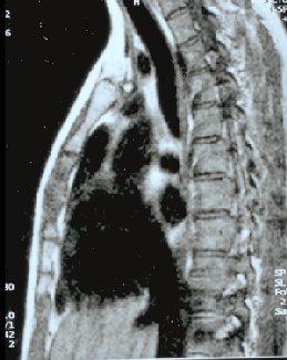 1-18-MRI_Sternumpseudarthrose.jpg