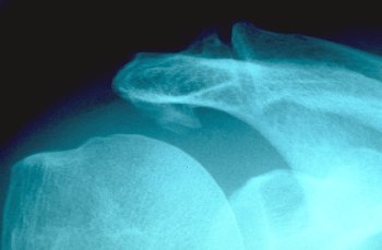 1-70-Osteophyt.jpg