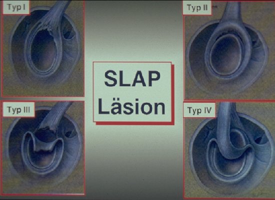 Slap Laesion Typen