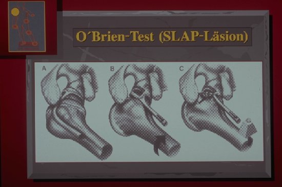 O Brien Test